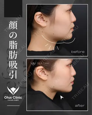 90 days after image