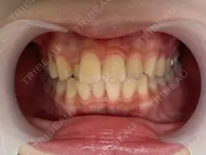 before image