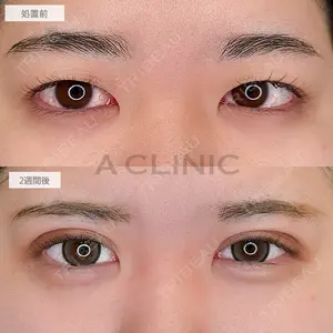 14 days after image