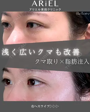 90 days after image
