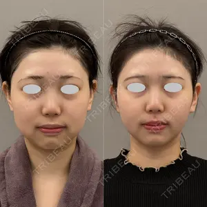 90 days after image