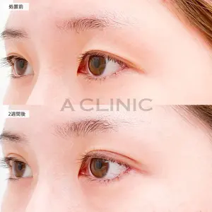 14 days after image
