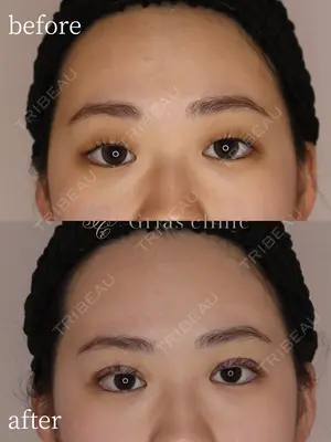 0 days after image