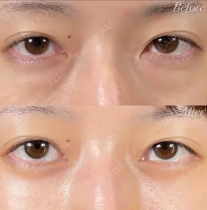 before image
