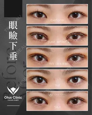 90 days after image