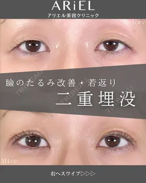 30 days after image