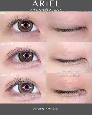 before image