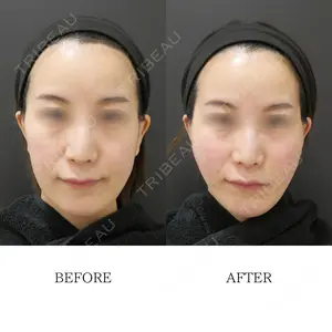 0 days after image