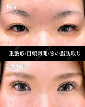 before image