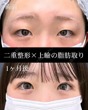 before image