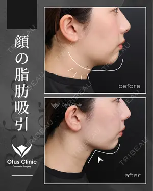 90 days after image