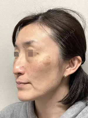 before image