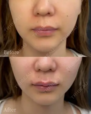 0 days after image