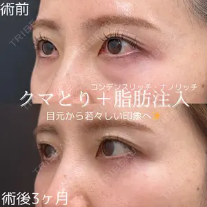 90 days after image