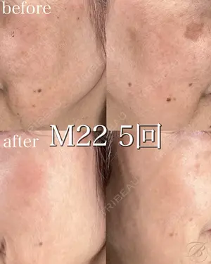 150 days after image
