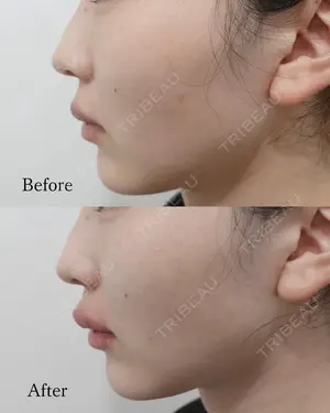 before image