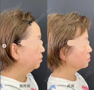 before image