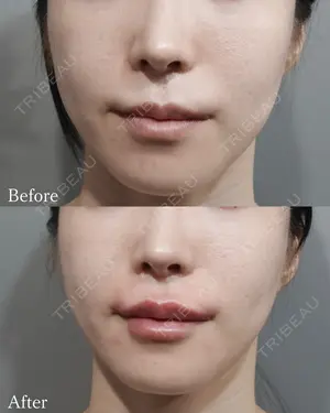 before image