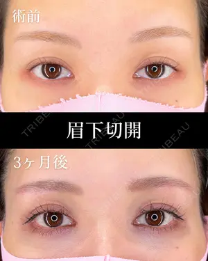 before image