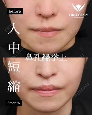 90 days after image