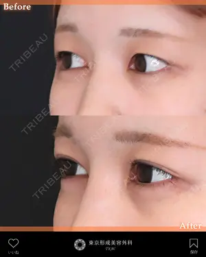before image
