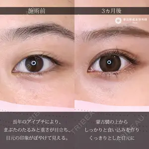 before image