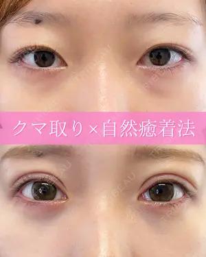 before image