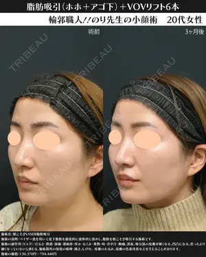 90 days after image