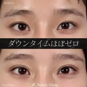 0 days after image