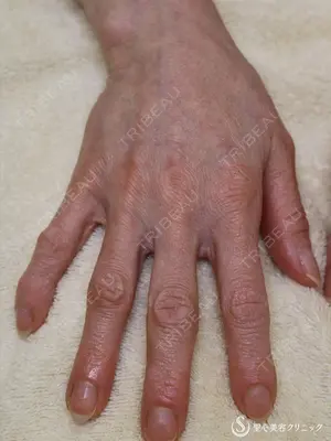 0 days after image