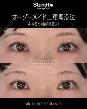 before image
