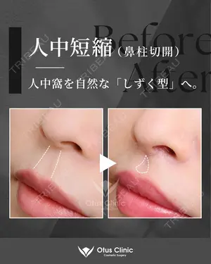 90 days after image