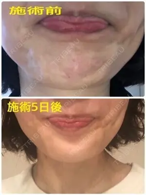 5 days after image