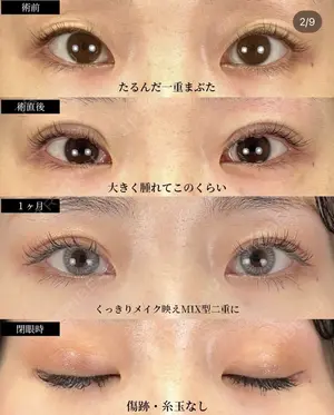 before image