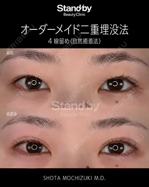 before image