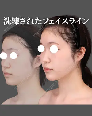90 days after image