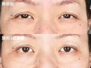 before image