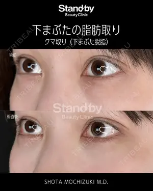 before image
