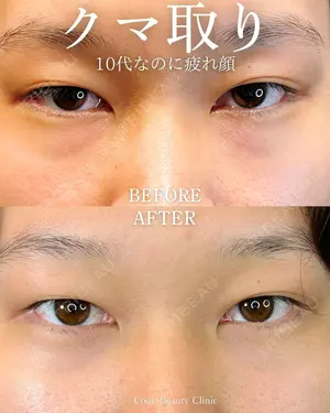 before image