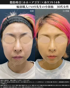 90 days after image