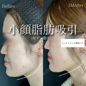 90 days after image