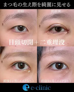 before image