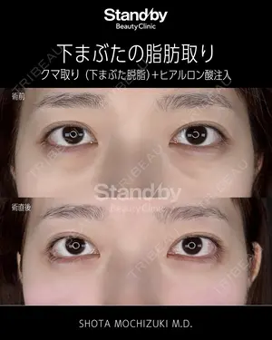before image