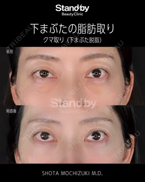 before image