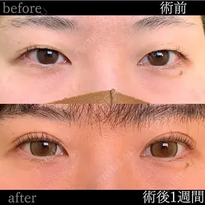 before image