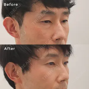 before image