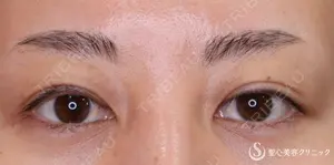 30 days after image