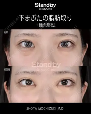 before image