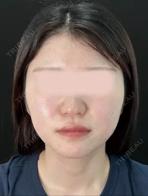 1 days after image