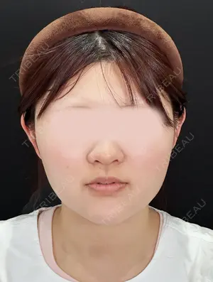 1 days after image